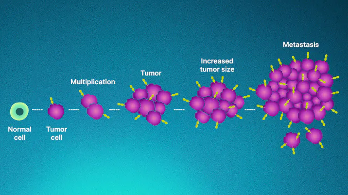 Tumor progression infographic. Tumor progression infographic.