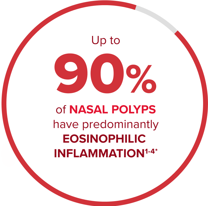 Up to 90 percent of nasal polyps have predominantly eosinophilic inflammation Up to 90 percent of nasal polyps have predominantly eosinophilic inflammation