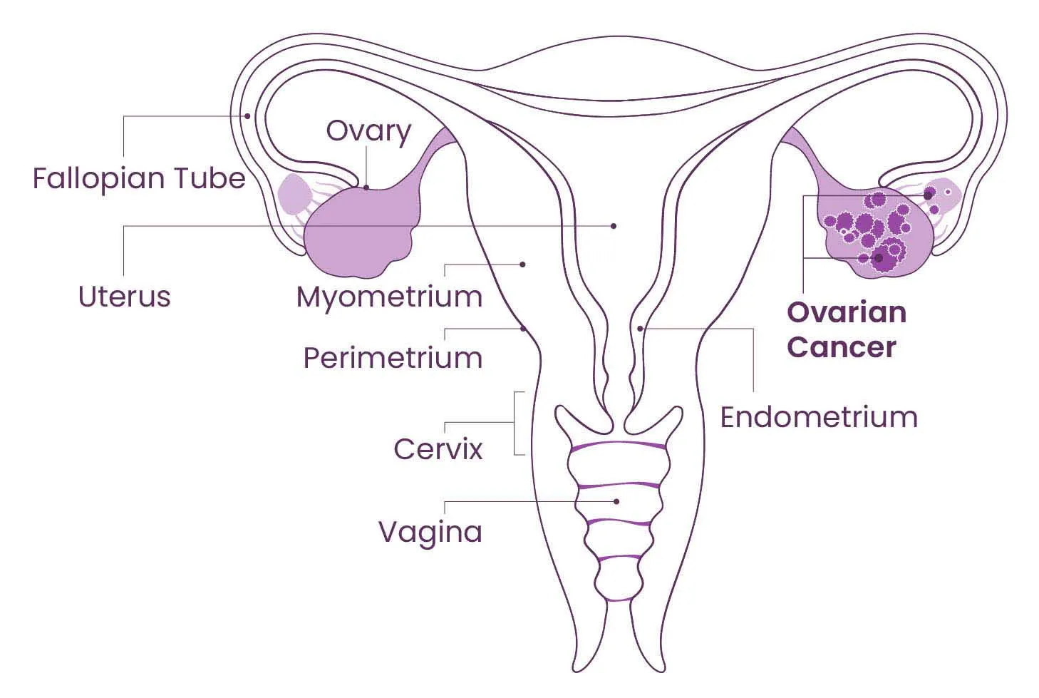 Anatomical diagram of the endometrium with ovarian cancer cells