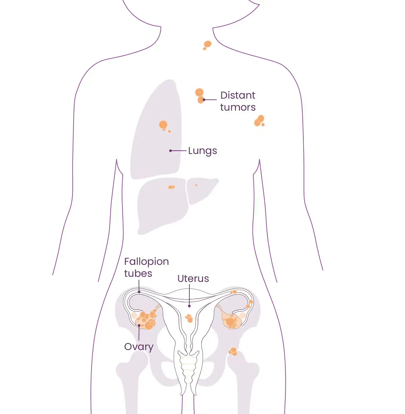 Anatomical diagram of the different stages of ovarian cancer