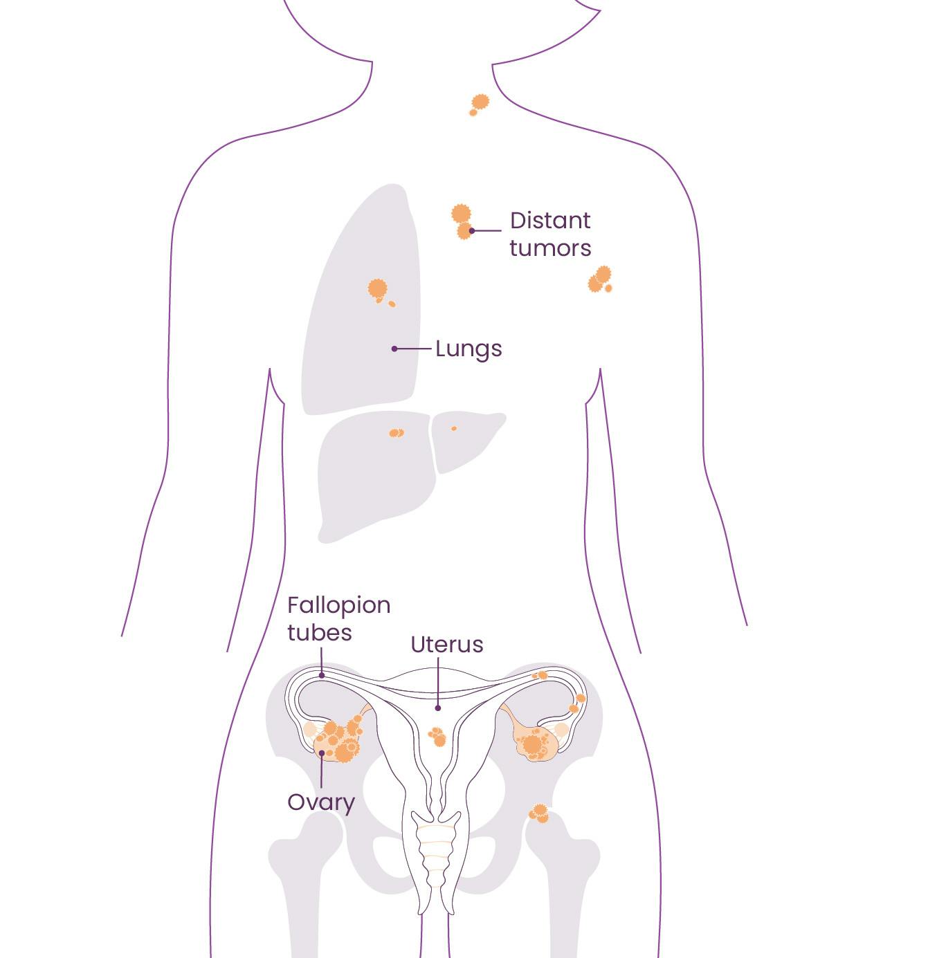 Anatomical diagram identifying the locations of the body impacted based on FIGO staging