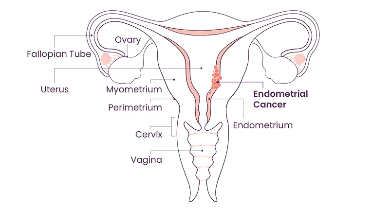 Anatomical diagram of the endometrium with endometrial cancer cells Anatomical diagram of the endometrium with endometrial cancer cells