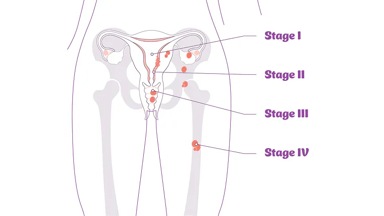 Anatomical diagram of the different stages of endometrial cancer Anatomical diagram of the different stages of endometrial cancer