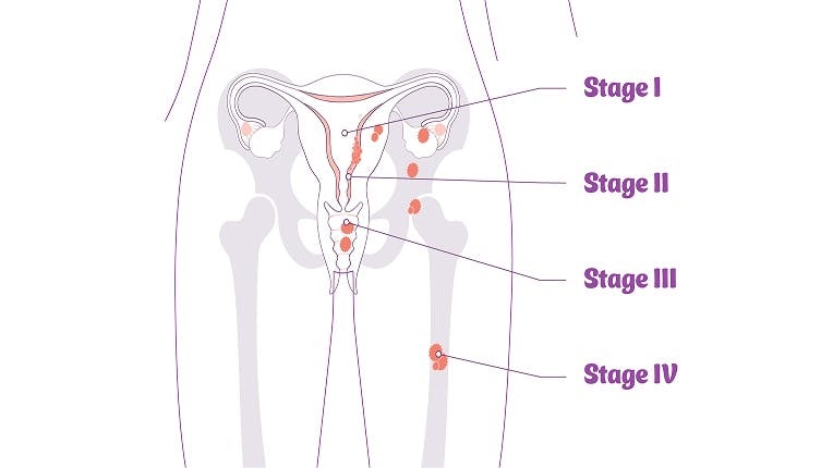 Anatomical diagram of the different stages of endometrial cancer Anatomical diagram of the different stages of endometrial cancer