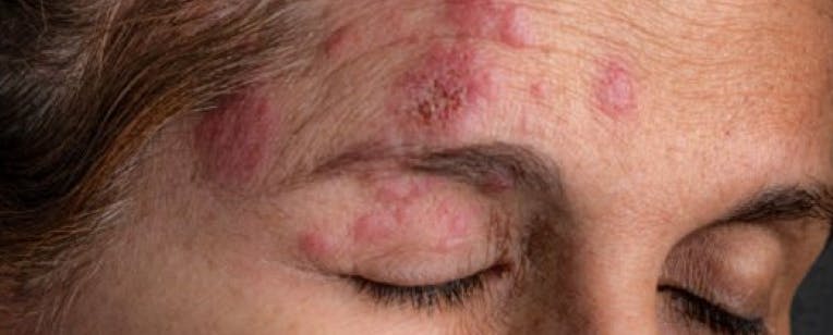 Image of a woman with herpes zoster ophthalmicus (HZO)