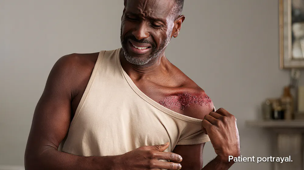Patient portrayal: man with burning shingles pain