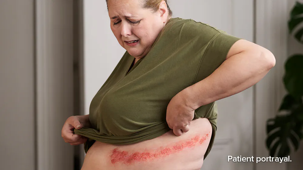 Patient portrayal: woman with electric shocks shingles pain