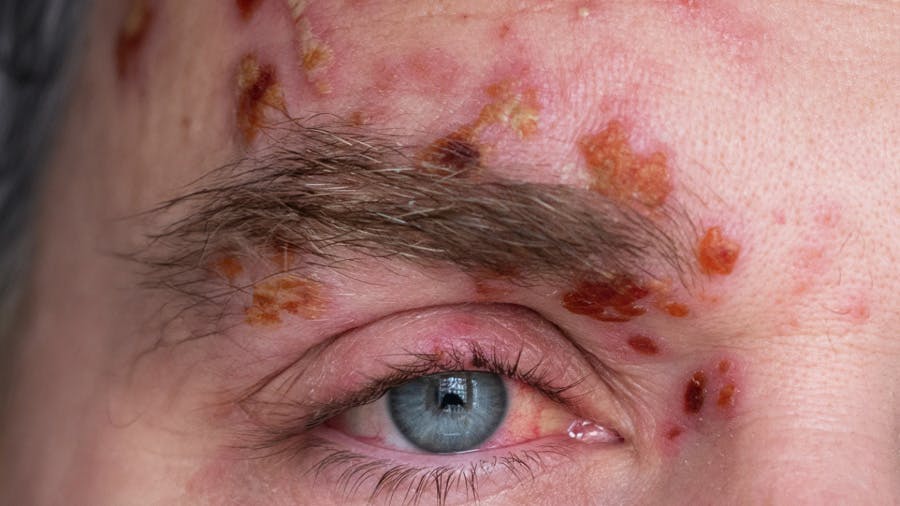 Close up of a man's eye with a herpes zoster opthalmicus outbreak