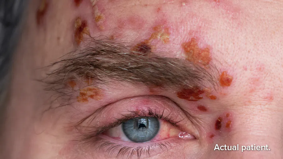 Actual patient: herpes zoster ophthalmicus (HZO) as a complication of shingles