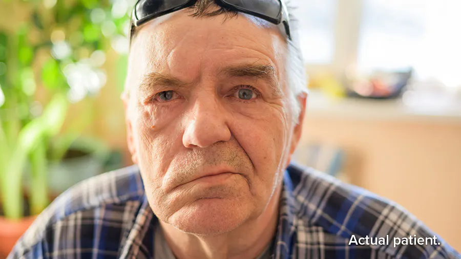 Actual patient: neurologic complications due to shingles