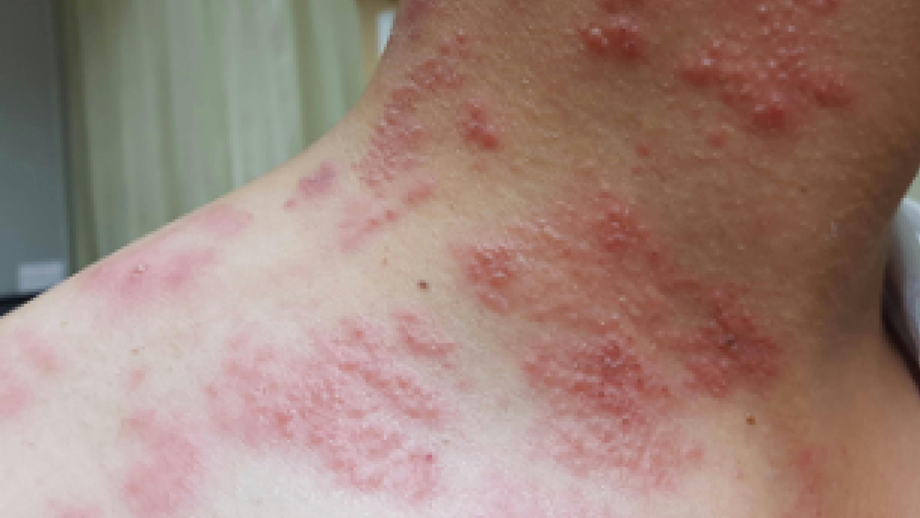 Rash on neck indicating disseminated herpes zoster