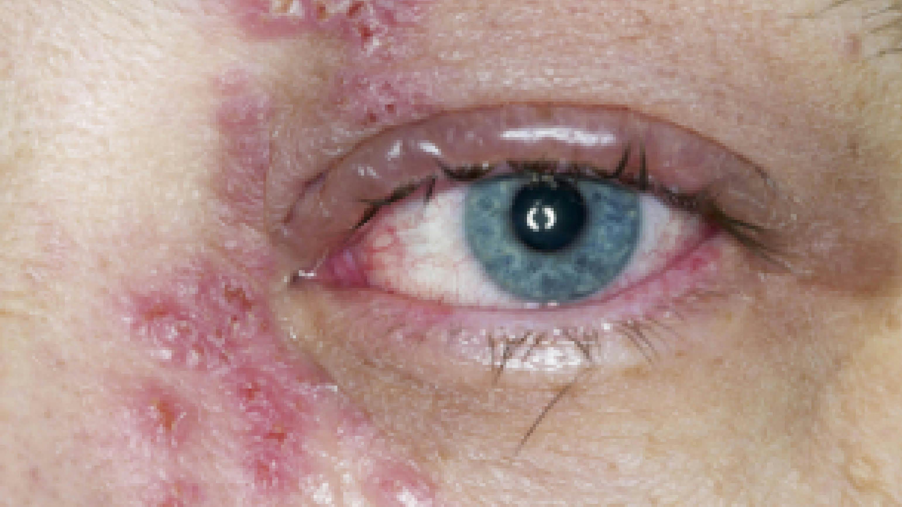 Rash around eye indicating herpes zoster ophthalmicus