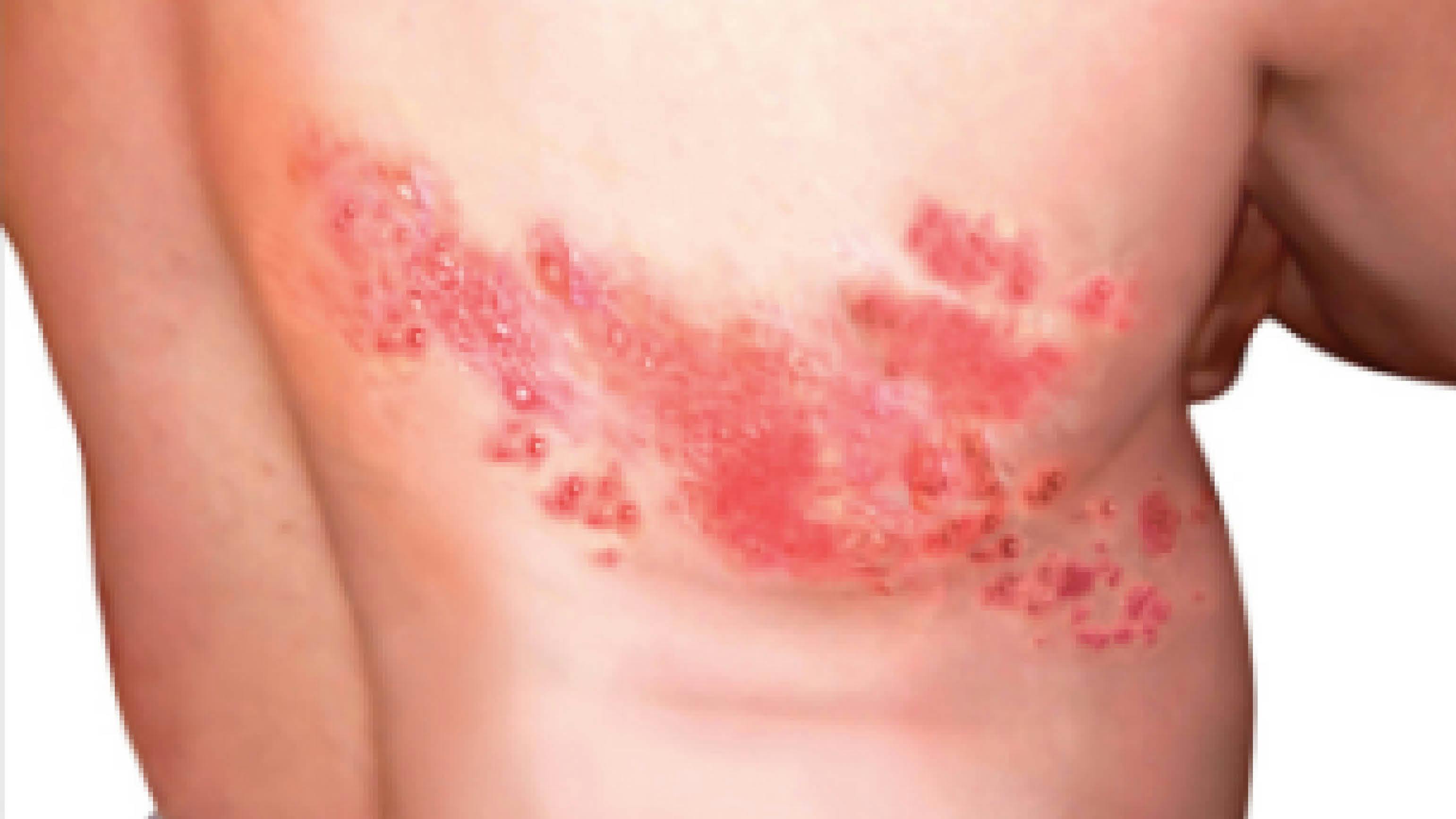 Shingles rash on back