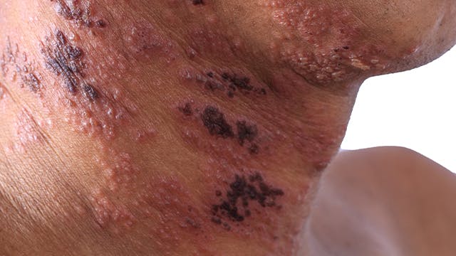 Acercamiento de una erupción en un cuello causada por la culebrilla