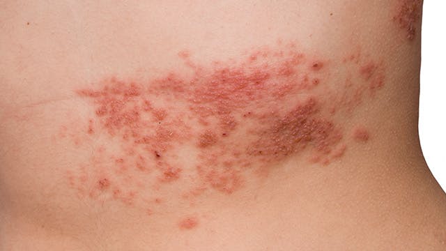 Acercamiento de una erupción en un torso causada por la culebrilla Acercamiento de una erupción en un torso causada por la culebrilla