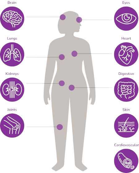 Lupus and lupus nephritis create inflammation that can lead to certain symptoms and organ damage