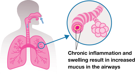 Chronic Bronchitis Graphic