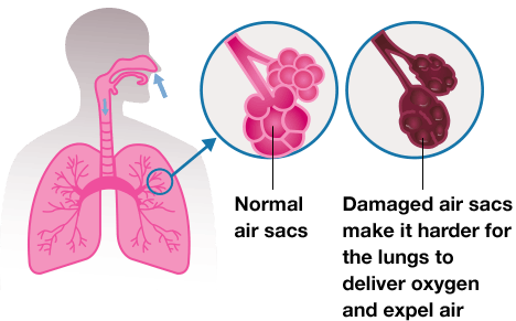 emphysema lung vs normal lung