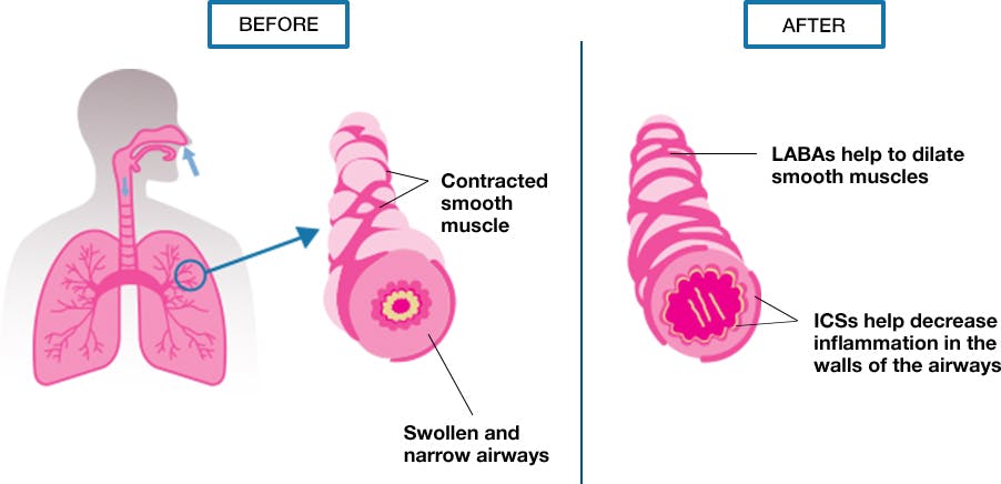 ICS and LABA Combination Treatments