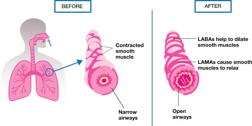 LAMA and LABA Combination Treatments (Dual Bronchodilators)