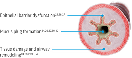 Key cytokines contribute to airway pathophysiology