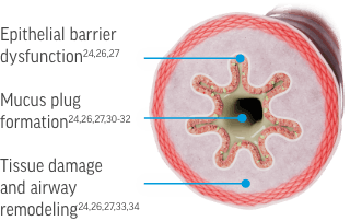 Key cytokines contribute to airway pathophysiology