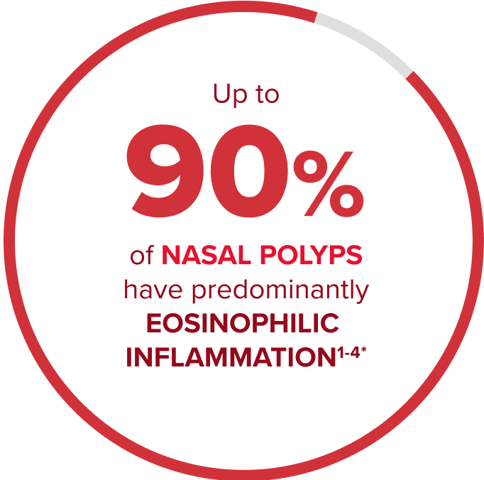Up to 90% of nasal polyps have predominantly eosinophilic inflammation