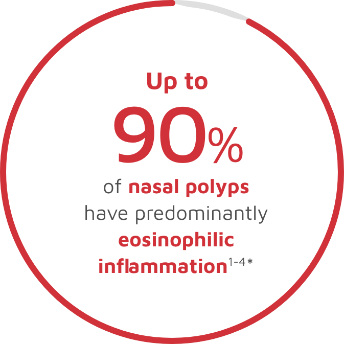 Up to 90% of nasal polyps have predominantly eosinophilic inflammation infographic