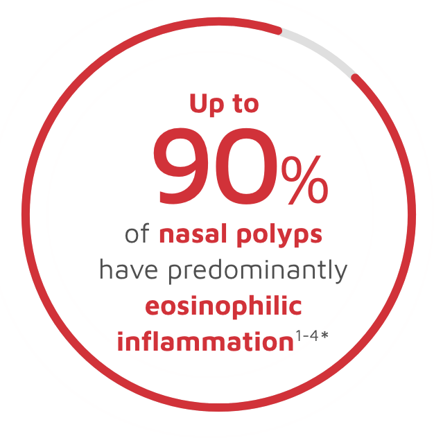 Up to 90% of nasal polyps have predominantly eosinophilic inflammation infographic