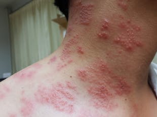 Picture of shingles on neck