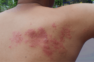 Picture of shingles on upper back