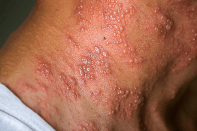 Picture of shingles on neck