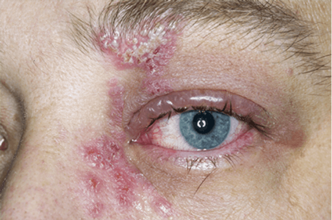 Picture of shingles on face