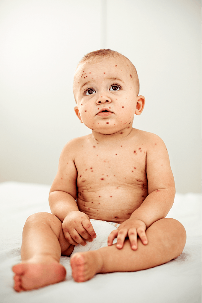 Chickenpox
