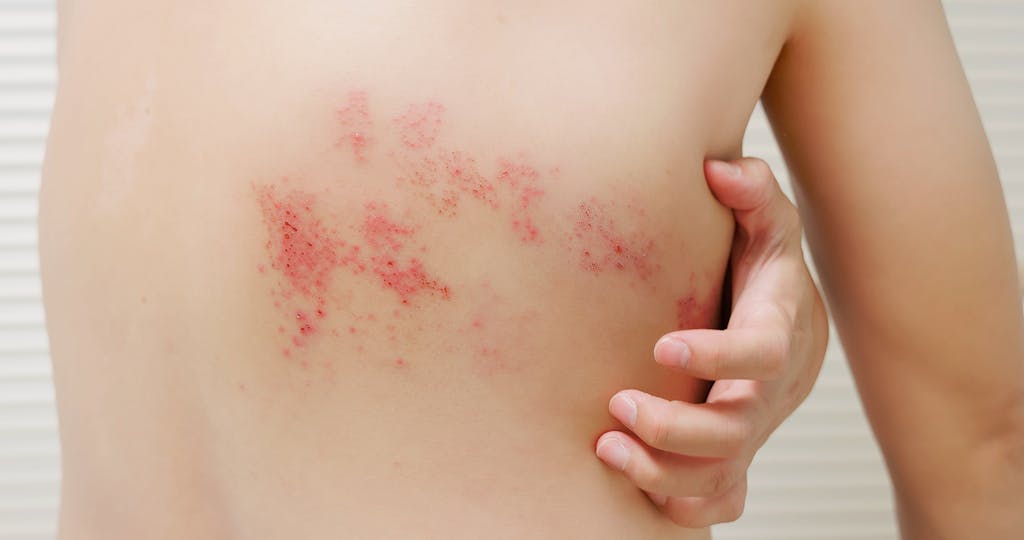 Shingles-and-Diabetes