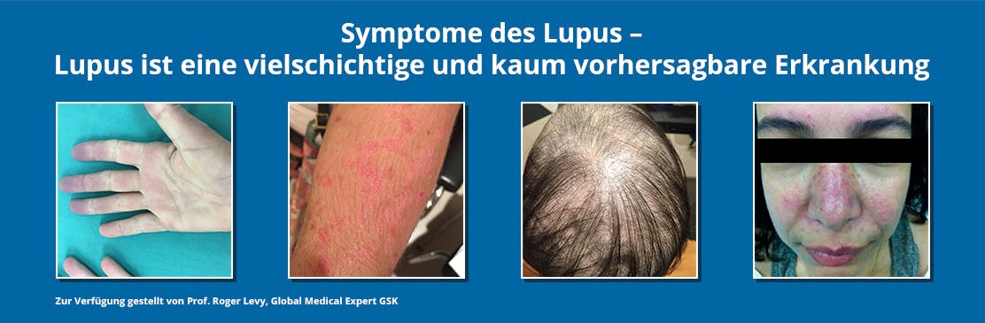 Symptome Lupus