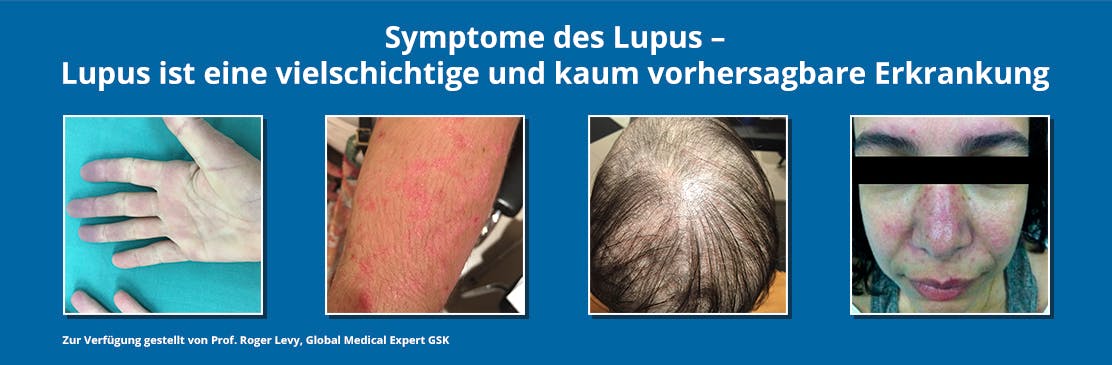 Symptome des Lupus erythematodes (SLE)