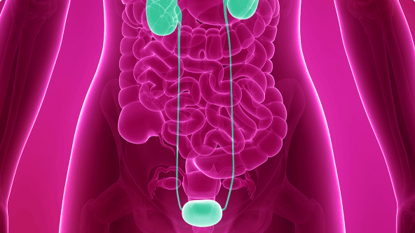 Complicated UTI image
