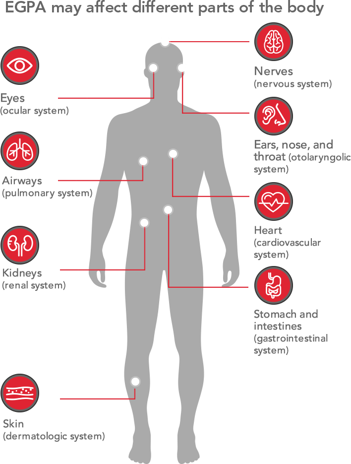 About EGPA | NUCALA (mepolizumab)