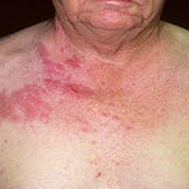 صورة لطفح جلدي ناتج عن مرض الحزام الناري (الهربس النطاقي) على صدر شخص