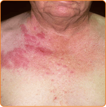 shingles-chest