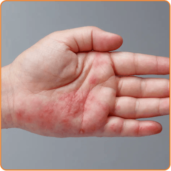 shingles-hand-2