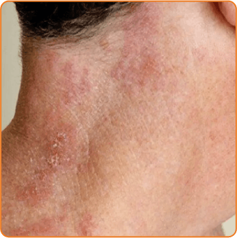 shingles-neck