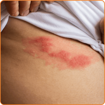 shingles-stomach