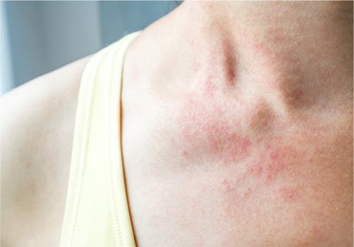 Image of shingles rash on neck and shoulder