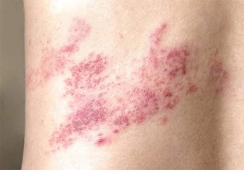 Shingles Symptoms What Is Shingles Shingles Symptoms What Is Shingles