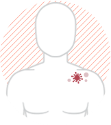 shingles pain symptom image shingles pain symptom image
