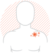 shingles rash symptom image shingles rash symptom image