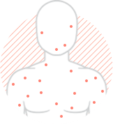 shingles chickenpox image shingles chickenpox image