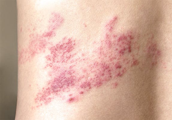 do shingles itch at first